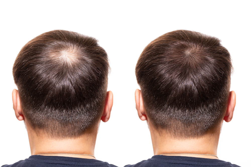 hair regrowth nearby