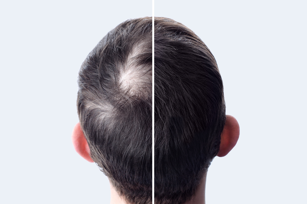 hair loss clinic